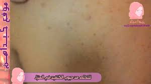 للتخلص من حبوب الكتفين في المنزل وصفة لعلاج الحبوب فى الكتف والرقبة Hd Youtube Map Content
