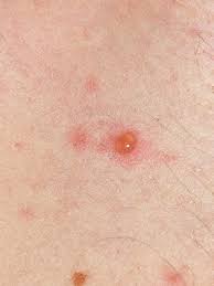 Image result for Varicella zoster on human skin