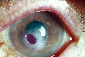 Formulary drug information for this topic. Keeping Herpes Under Control