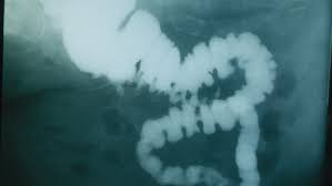 Meanwhile, about 200,000 people in the united states go to the hospital for diverticulitis each year, according to the department of surgery at the. Can I Ever Recover From Diverticulitis The New York Times