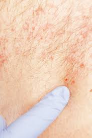 This process is divided into several steps such as just because a vaccine formulation works in animal models does not guarantee that it will work in in these clinical trials, information on how long it takes for the vaccine to provide immunity after the. How Long Does Shingles Last Timeline And Treatment