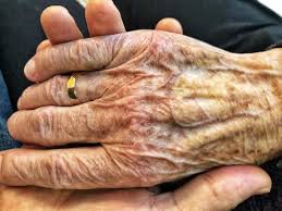 May 14, 2021 · parkinson's disease is a chronic disorder of the nervous system, which is made up of pathways of cells and neurons that send and receive signals throughout your body. Parkinson S Disease Signs And Symptoms