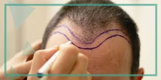 Ricapitolando, l'autotrapianto dei capelli senza rasatura è eseguito da professionisti del settore estremamente competenti e con anni di . Cos E Il Trapianto Di Capelli Senza Rasatura Znz Grup