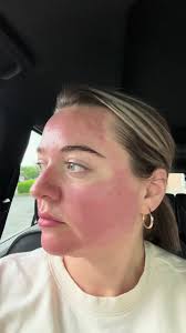 First round of microneedling progress.