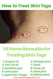 Skin Tags They Are Very Annoying And Not Pretty To Look At But They Can Not Hurt One They Skin Tags Home Remedies Home Remedies For Skin Skin Tag On Eyelid