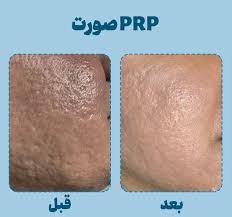 پی‌آرپی