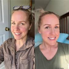 Calm redness with the Series 2 Red Light Mask for faster skin recovery.  @becky_wren , runner up of the 2025 before and after competition.