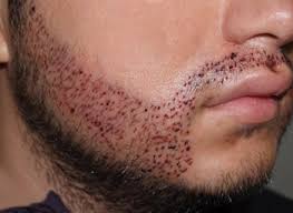 Although i'd ask a doctor first and read the label before putting it on your face. Hair Transplant Trend Extends To Beards With 600 Increase