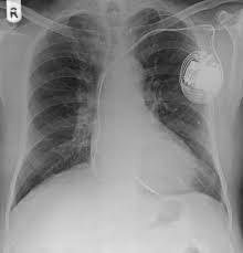 If the device is interrogated, code z45.018 would be reported as it is no longer just the presence of the device but attention to the device. Cardiac Conduction Devices Radiology Reference Article Radiopaedia Org