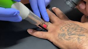 So, if you're planning a tattoo, you should think before you ink, but more so in terms of what you want and the artist you want to do the work. Free Laser Tattoo Removals For Ex Convicts