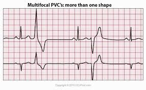 Pin On Ekg