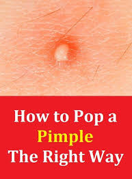 How To Pop A Pimple The Right Way In 2020 Pimples Hair Beauty Facial Wash