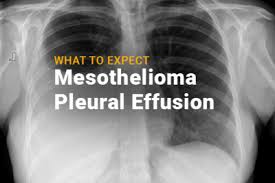 Mesothelioma is a cancer that attacks the mesothelium. Most Pleural Mesothelioma Patients Experience Pleural Effusion The Buildup Of Fluid In The Pleural Space Around Mesothelioma Pleural Effusion Fluid In Lungs