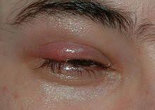 Hordeolum Wikipedia