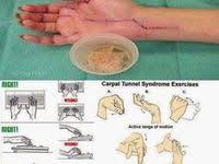 Carpal Tunnel Syndrome American Family Physician Carpal Tunnel Syndrome Carpal Tunnel Medical Knowledge