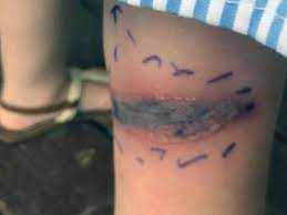 How do i prevent spider bites from black widows? This Girl S Bruise Was Actually Venom From A Black Widow Spider Bite Self