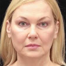 Face Procedures Chesterfield