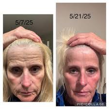 Holy!!!! This is my beautiful friend Colleen Mchale-Harvey and her results  with the new Neo-Filler! Check it out 👇 In her own words "Ok guys!!! Blown  away. Check out under my eyes