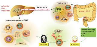 The disease is metastatic colorectal cancer, not liver cancer. Emerging Role Of Immunotherapy For Colorectal Cancer With Liver Metast Ott