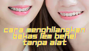 Check spelling or type a new query. Cara Menghilangkan Bekas Lem Behel Tanpa Alat