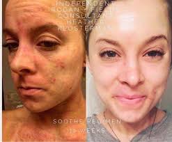 It doesn't serve anyone when you sit around thinking you're a big piece of  crap!” Today I had a small mass removed inside my sinuses. No big deal but  hoping that it's