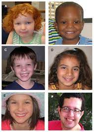 Figure 1 Individuals With Potocki Lupski Syndrome The Genereviews Ncbi Bookshelf