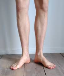 Image result for Out-toeing