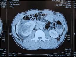 Image result for Perinephric Abscess