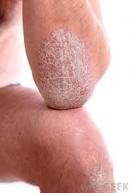 What Are Some Home Remedies For Psoriasis With Pictures