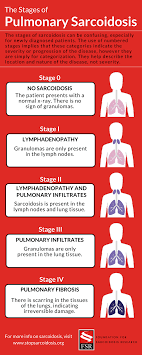 It causes small lumps of inflammatory cells in the lungs. The Stages Of Pulmonary Sarcoidosis What Do They Really Mean Foundation For Sarcoidosis Research