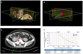 Access over 135 million publication pages and stay up to date with what's happening in your field. Frontiers Feasibility And Clinical Value Of Ct Guided 125i Brachytherapy For Pain Palliation In Patients With Breast Cancer And Bone Metastases After External Beam Radiotherapy Failure Oncology