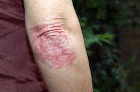 A prevalência estimada de psoríase varia de 0,5 a 4,6% em todo o mundo. Entenda Agora O Que E Psoriase E Como Tratar Partmed A Maior Rede De Clinicas Medicas Do Brasil