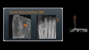 Image result for Osteomyelitis