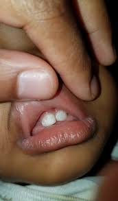 Holes On Baby Teeth March 2016 Babies Forums What To Expect