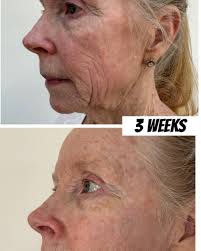 🚨 Coming to STL Body May 1! 🚨 TOPICAL. NO NEEDLE. NO DOWNTIME.  Introducing the Neo-Filler — the game-changer your skin has been waiting  for! It mimics the action of filler and