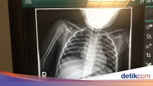 Adalah bahwa thoracoplasty adalah (pembedahan) operasi dada, biasanya melibatkan pengangkatan tulang rusuk sementara thorax adalah bagian tengah dari tiga divisi berbeda dalam. 8 Foto Rontgen Unik Yang Bisa Bikin Ketawa