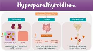 Image result for Hyperparathyroidism