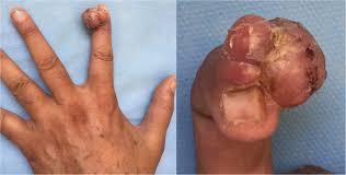 Image result for Glomus tumor