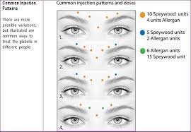 What areas can botox® be injected? Top 3 Botox Injection Patterns Markup Skinviva Training