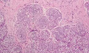 Atypical Hyperplasia Uic Pathology Atypical Hyperplasia Pathology Ductal Hyperplasia