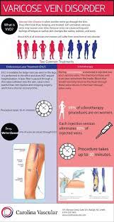 Pin On Varicose Veins