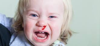 Image result for Epistaxis