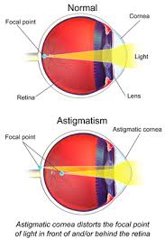 astigmatism wikipedia