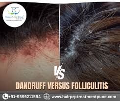 Image result for folliculitis symptoms