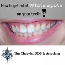 Usually, white spots on teeth are a cosmetic issue but sometimes, they can lead to tooth decay too and thus it becomes essential to remove white spots on teeth. How To Get Rid Of White Spots On Your Teeth Dr Chauvin