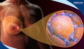 Cáncer de mama en hombres: cómo reconocer los síntomas y comprender los  riesgos | Vaidam Health