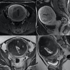 Reducing carbs and replacing them with healthy fats can cause your body to enter a metabolic state known as ketosis. Uterine Fibroids Surprising Things To Know