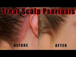 Scalp psoriasis is a form of plaque psoriasis. How To Treat Scalp Psoriasis 5 Natural Ways For Treating Psoriasis Of The Scalp At Home Youtube