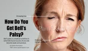 In bell's palsy, the affected nerve becomes inflamed due to injury or damage. How Do You Get Bell S Palsy How Long Does It Take To Recover From Bell S Palsy