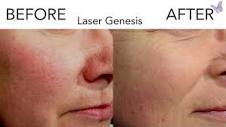 Laser Genesis for Skin Tone | Derma Health Institute